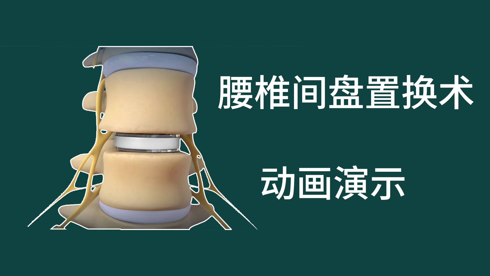 腰椎間盤置換術