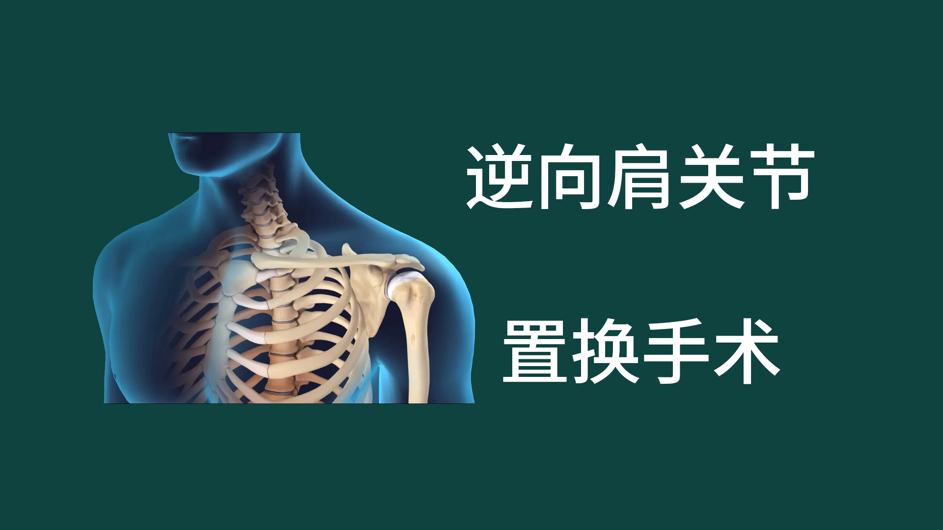 逆向肩關節置換手術